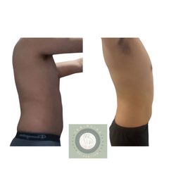 Unwinding Relaxation - Full body contouring results. Before and after 12 consistent sessions