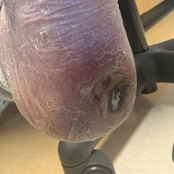 Mom's wound