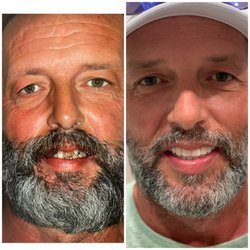 Dr. Patty Miami Cosmetic Dentistry - All on 4 Implants MakeOver