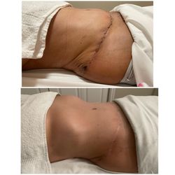 Escape Day Spa - Post Operation Lymphatic Drainage