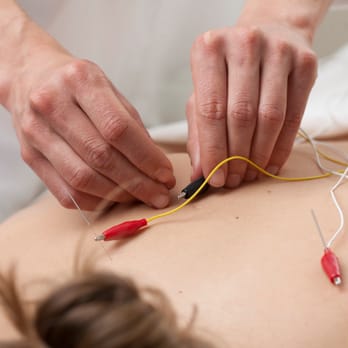 Melida Acupuncture - Electro-Acupuncture is a form of acupuncture where a small electric current is passed between pairs of acupuncture needles for pain relief - Acupuncture Near Me - San Diego, California Melida Acupuncture - Electro-Acupuncture is a form of acupuncture where a small electric current is passed between pairs of acupuncture needles for pain relief - Acupuncture Near Me - San Diego, California