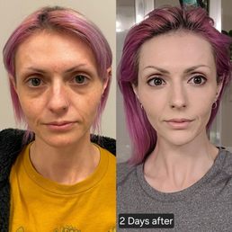 2 days after Under eye filler and facial balancing. 2 days after Under eye filler and facial balancing.