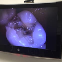 West University Family Dentistry - Bad filling- "before"