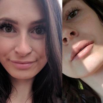 Amanda Rose Esthetics - Before and after lips - Skin Care Near Me - Sterling, Virginia