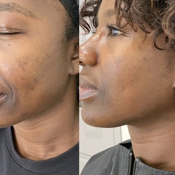 The Peel Connection - Much smoother, and even toned - Skin Care Near Me - Chicago, Illinois The Peel Connection - Much smoother, and even toned - Skin Care Near Me - Chicago, Illinois