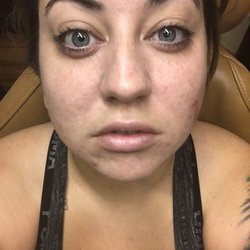 Aesthetic Laser Care - Left side done, right untouched