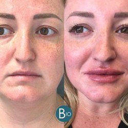 BioSpa - Before & After Botox and Filler