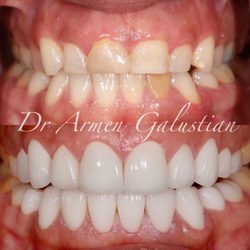 Calabasas Dental Institute - Smile makeover with gum contouring and porcelain veneers