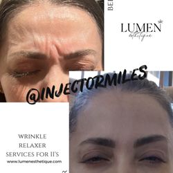 Wrinkle Relaxer Services for 11's by injector Miles