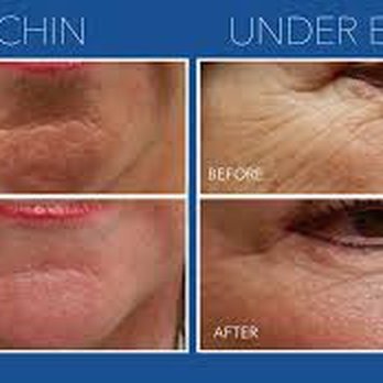 Essentially Bare - Micro needling Staff Favorite - Hair Removal Near Me - Cambridge, Massachusetts