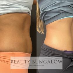 Beauty Bungalow Face and Body Sculpting - EON Laser