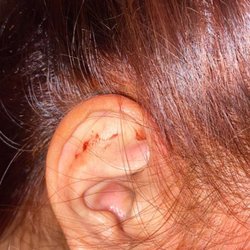 Salon Gioia - Ear burns