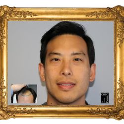 PANINE, MD - Chicago Hair Transplant Clinic - Real Patients with Real Results. Just look at this hair transplant result from Dr. Panine at CHICAGO HAIR TRANSPLANT CLINIC!