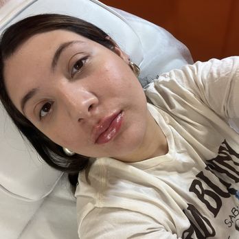 Younger World Med Spa - Lip filler - Medical Spas Near Me - Downey, California Younger World Med Spa - Lip filler - Medical Spas Near Me - Downey, California