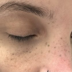 Haven Studio - Permanent freckle tattoo five years later still look like black heads.