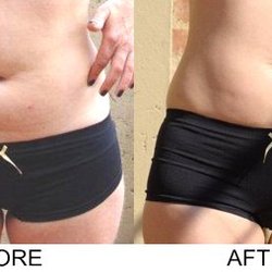 Columbus Go Lite Lipo Lounge - Reduce visible signs of cellulite in just one visit.