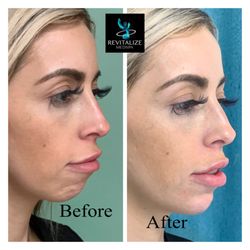 Revitalize Medspa - Before and After Chin Filler for facial profile and jawline improvement. Fillers are performed at Revitalize Medspa