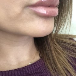 Derma Health Skin & Laser - Lips 6 days past treatment side view!