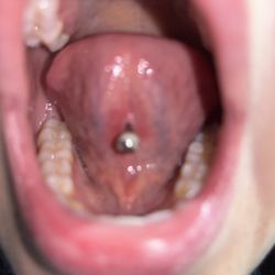 Irritation and white build up from poor quality jewelry on a semi fresh new piercing orally. This isn't from not cleaning it's from jewlry