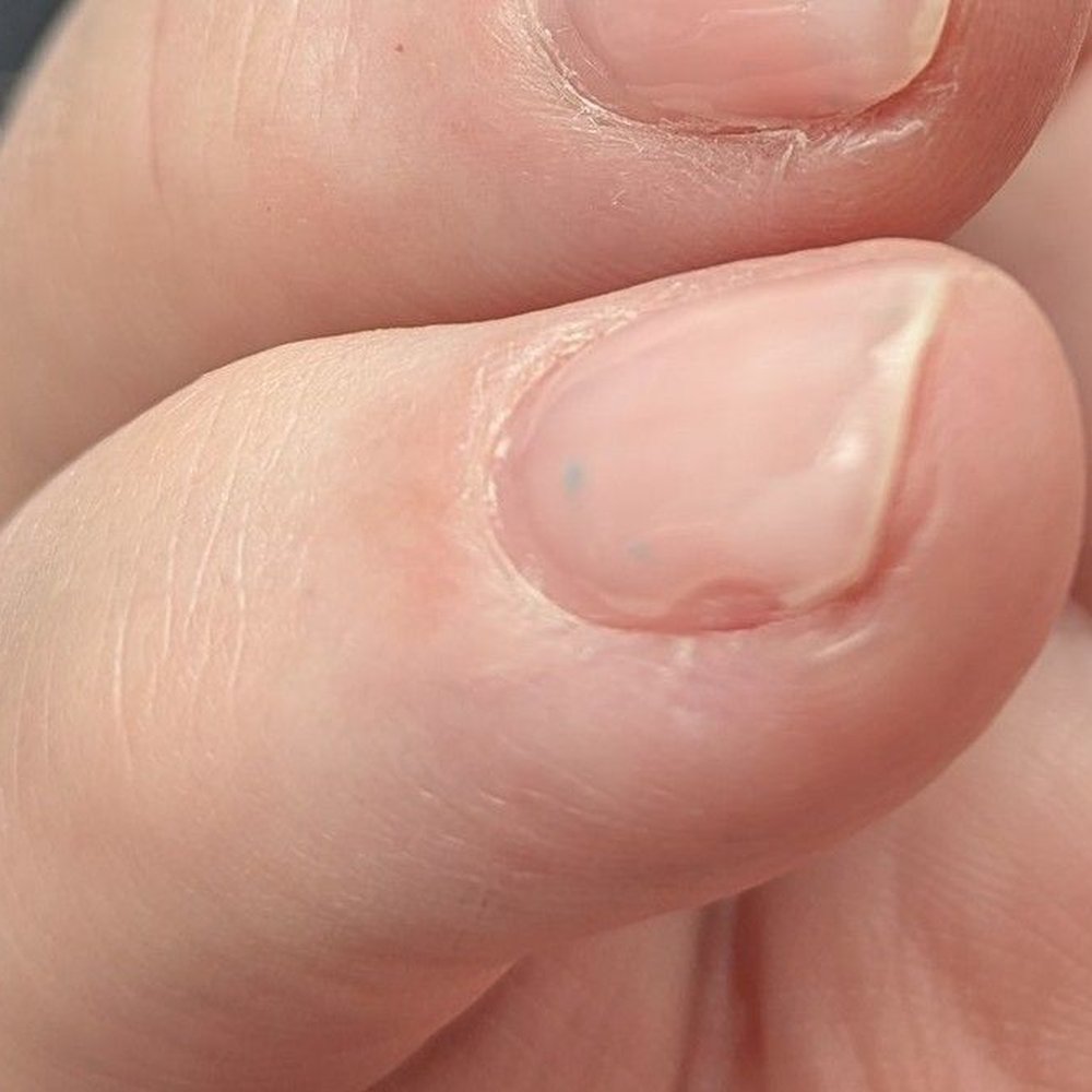 Missing and bulging gel. Missing and bulging gel.
