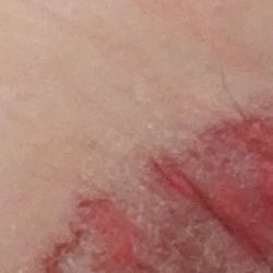 Halcyon Center - Picture of Bacterial Cellulitis from unsanitary conditions