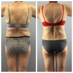 Reformation Body Solutions - Combination of Lipomelt and Ideal Protein weight loss program. 27 pounds in 12 weeks.