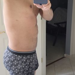 Metamorphosis Plastic Surgery - Botched Etching by Metamorphosis Dr. Markmann