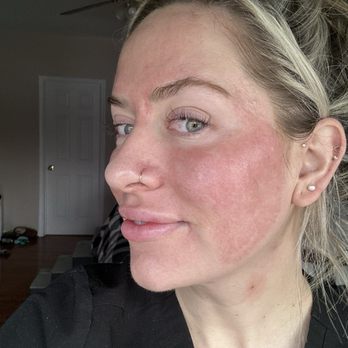 Jason Emer, MD - Post 1 month CO2 and halo - Dermatologists Near Me - New York, New York Jason Emer, MD - Post 1 month CO2 and halo - Dermatologists Near Me - New York, New York