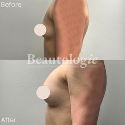Jon Wilensky, MD, MBA, FACS - Bilateral Breast Augmentation with 350ml Saline Implants Before and After