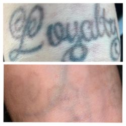First Class Tattoo Removal Service - before treatment and after 4 treatments