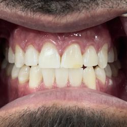 Duke City Dental & Hygiene - * #BeforeAndAfter
* #WhiteningTreatment
* #WhitenedTeeth