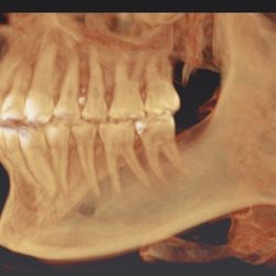 Richard J Ewing, DDS - CBCT reconstruction of Dr.Randall Ewing's dentition (teeth) and surrounding structures
