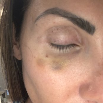 Redefine Aesthetics - Week after the treatment and I'm still covered in bruised. - Medical Spas Near Me - Kissimmee, Florida Redefine Aesthetics - Week after the treatment and I'm still covered in bruised. - Medical Spas Near Me - Kissimmee, Florida