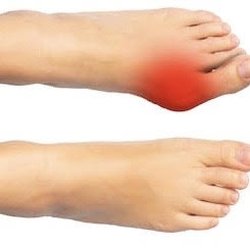 Joseph Ripepi, DPM -  Ripepi Foot & Ankle Clinics - Get rid of your bunion today!