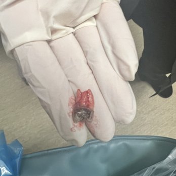 ASAP Dental Care - Horrible cavity - Oral Surgeons Near Me - Jacksonville, Florida