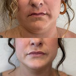 Lip Filler