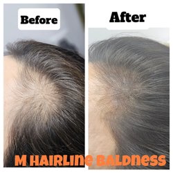 Grow on Scalp Care & Tattoo - Covered M-shaped baldness with scalp tattoo.