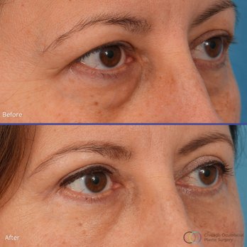 Chicago Oculofacial Plastic Surgery - Our 50-year-old patient looks brighter, younger, and more refreshed following her quad blepharoplasty with browpexy. - Plastic Surgeons Near Me - Chicago, Illinois