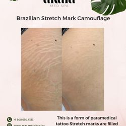 Akala Med Spa - Stretch Mark Camouflage