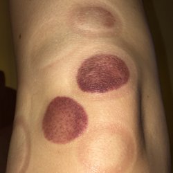 Back In Action Massage - Cupping session on the knee. As you can see, there's a lot of stagnation in the darker colors.