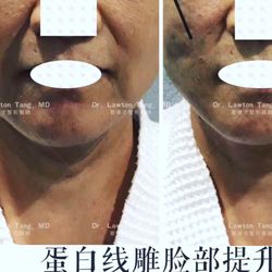 Angel Plastic Surgery - I have been doing threadlift with the original inventor since 2005.