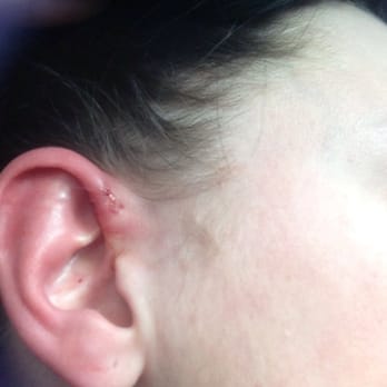 Human Kanvas - Ear is left sore and scarred - Piercing Near Me - Calgary, Alberta Human Kanvas - Ear is left sore and scarred - Piercing Near Me - Calgary, Alberta