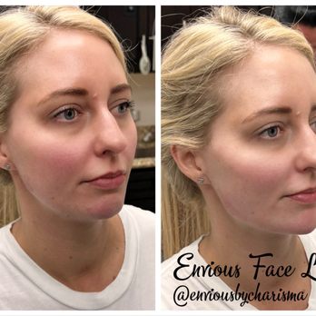 Mansfield Aesthetics - Filler is used to contour the face. - Medical Spas Near Me - Mansfield, Texas Mansfield Aesthetics - Filler is used to contour the face. - Medical Spas Near Me - Mansfield, Texas