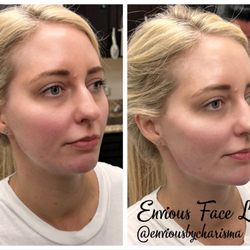 Mansfield Aesthetics - Filler is used to contour the face.