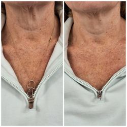 New Ro Aesthetics - Neck lift treatment