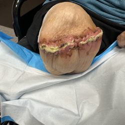 The Villages Rehab and Nursing Center - Puss filled stitches