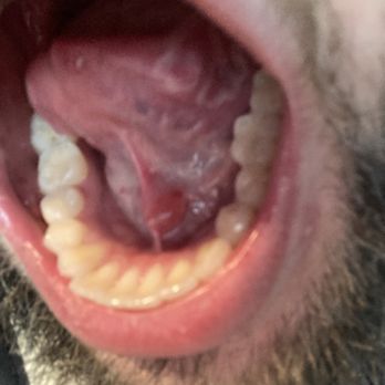 High Country Dental - High Country Dental cut under my tongue causing ranula - General Dentistry Near Me - Rio Rancho, New Mexico High Country Dental - High Country Dental cut under my tongue causing ranula - General Dentistry Near Me - Rio Rancho, New Mexico