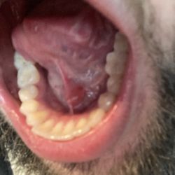 High Country Dental - High Country Dental cut under my tongue causing ranula