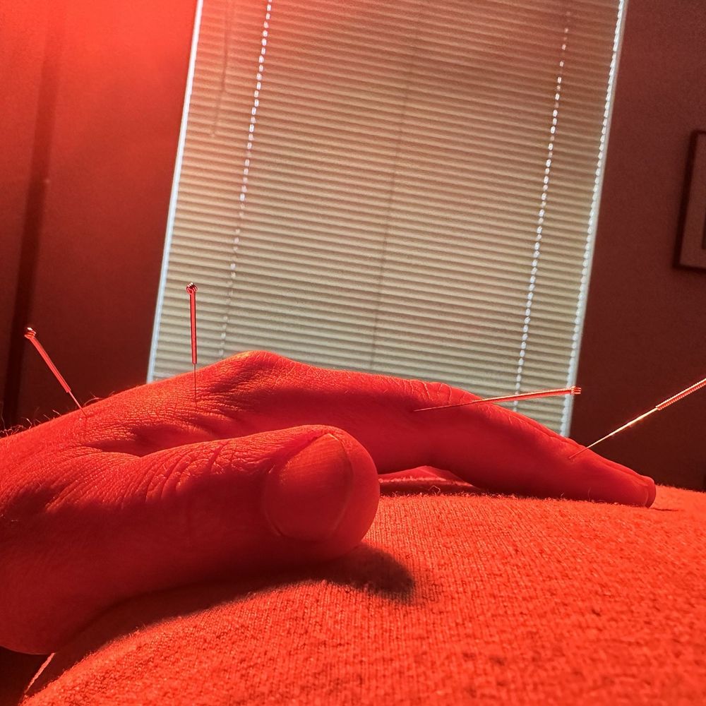 Jason Su, LAc - The hand I injured with four acupuncture needles and a heat lamp. - Acupuncture Near Me - San Leandro, California