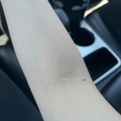 Quest Diagnostics - No bruising!